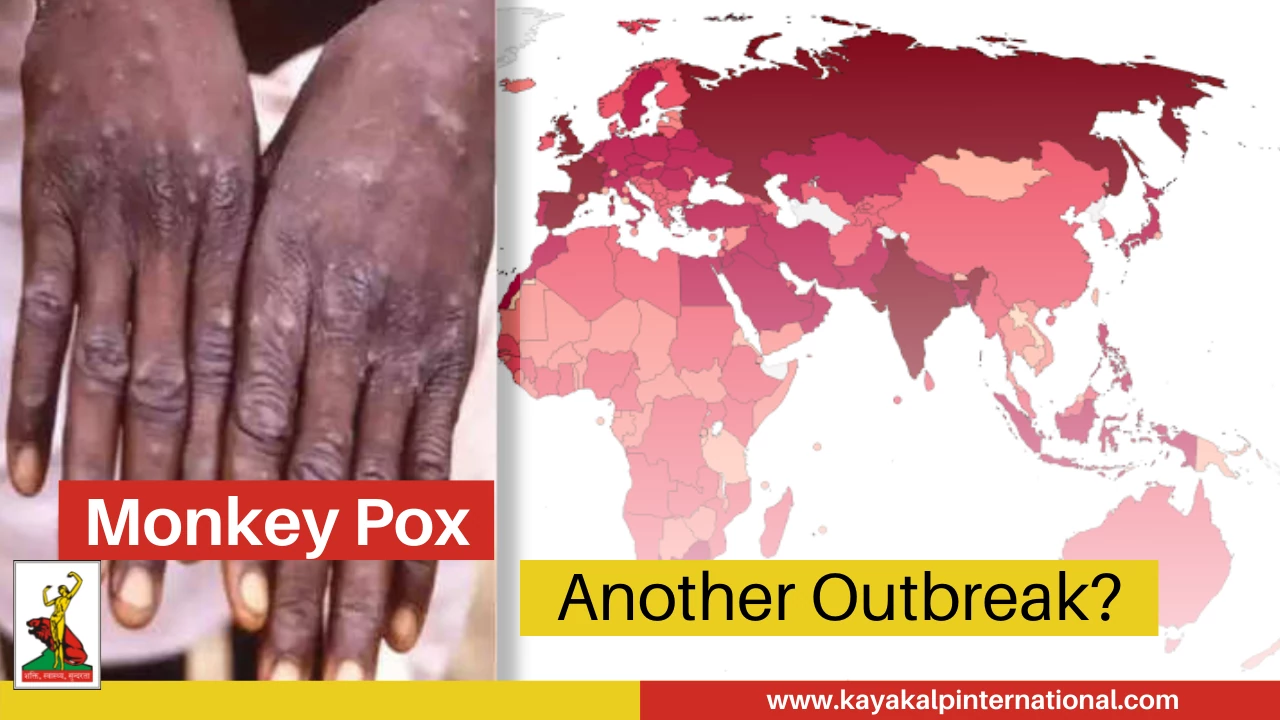 You are currently viewing Monkey Pox- Another Breakout