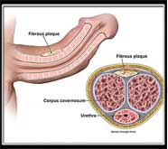 affordable male sexual problems treatment in mumbai