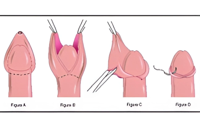 renowned circumcision treatment near me circumcision treatment in mumbai