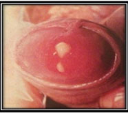 matchless male sexual problems treatment in mumbai