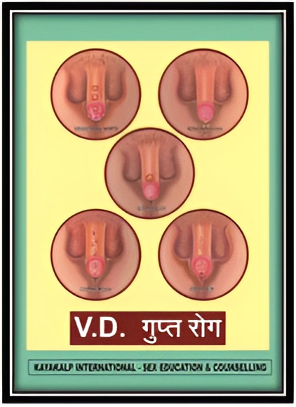 gupt rog treatment in india